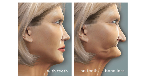 bone loss, no teeth, dentures