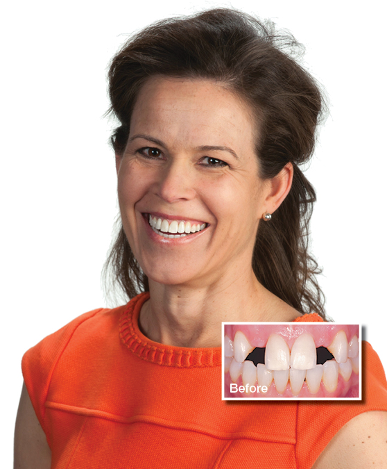 Kristie smiling with dental implant teeth