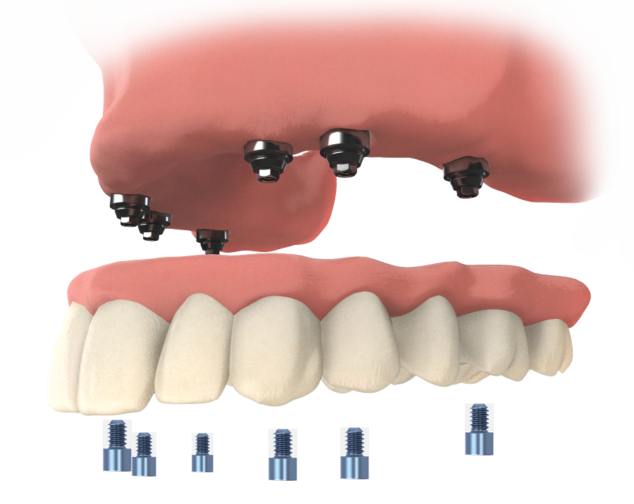 Dental implants for upper teeth
