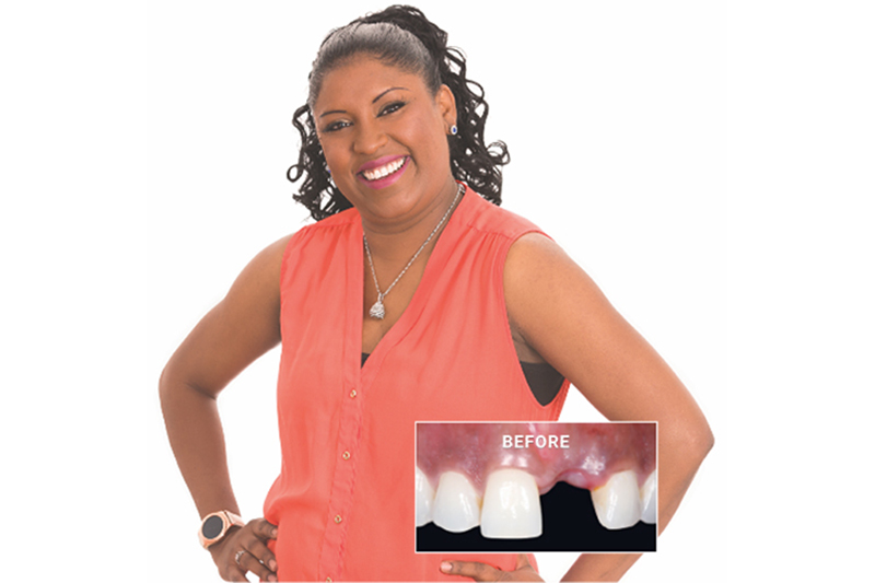 Marcia before and after dental implant