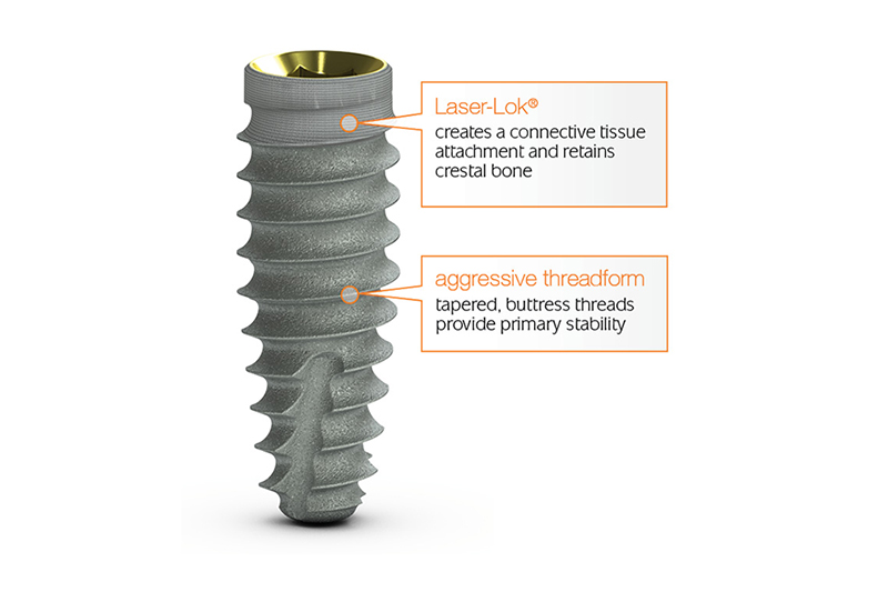how dental implants are made, Laser-Lok