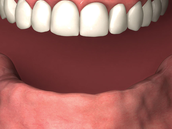 Before: Example of typical patient with missing teeth.