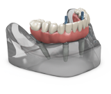 TeethXpress full-mouth dental implants