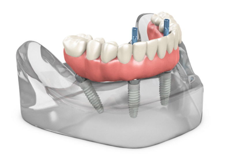 dental implants, implant-supported dentures, full mouth dental implants, TeethXpress